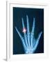 X-ray of hand with diamond ring-Thom Lang-Framed Photographic Print