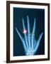 X-ray of hand with diamond ring-Thom Lang-Framed Photographic Print