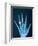 X-ray of hand with diamond ring-Thom Lang-Framed Photographic Print