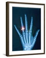 X-ray of hand with diamond ring-Thom Lang-Framed Photographic Print