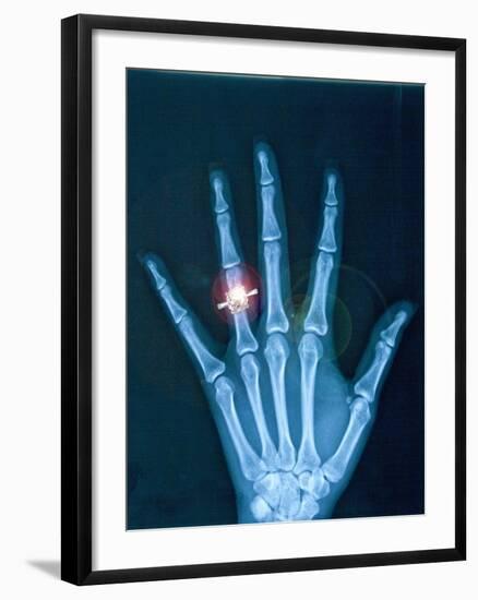 X-ray of hand with diamond ring-Thom Lang-Framed Photographic Print