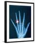 X-ray of hand with diamond ring-Thom Lang-Framed Photographic Print