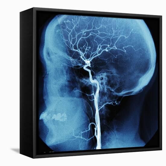 X-Ray of Human Head-Robert Llewellyn-Framed Stretched Canvas