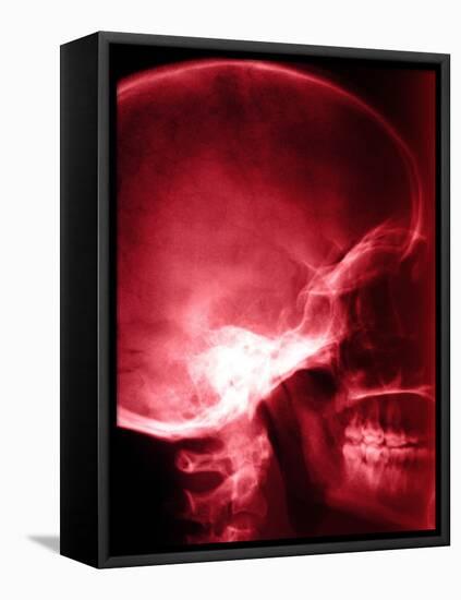 X-Ray of Human Skull-null-Framed Stretched Canvas