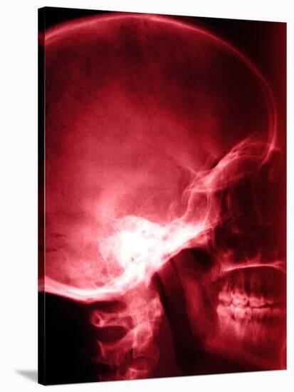 X-Ray of Human Skull-null-Stretched Canvas