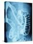 X-Ray of Intestines-Robert Llewellyn-Stretched Canvas