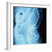 X-Ray of Intestines-Robert Llewellyn-Framed Photographic Print