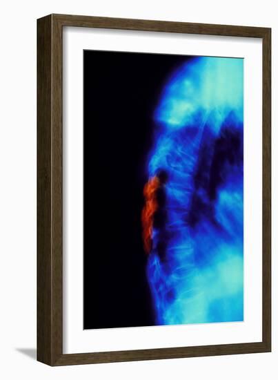 X-ray of Osteoporosis of the Thoracic Spine-Science Photo Library-Framed Photographic Print