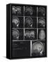 X-Ray Photographs of Person's Skull-null-Framed Stretched Canvas