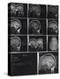 X-Ray Photographs of Person's Skull-null-Stretched Canvas