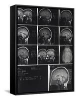 X-Ray Photographs of Person's Skull-null-Framed Stretched Canvas