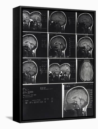 X-Ray Photographs of Person's Skull-null-Framed Stretched Canvas