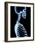 X-Ray Skeleton on Black-posteriori-Framed Art Print