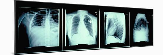 X-Rays of Human Chest-null-Mounted Premium Photographic Print