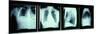 X-Rays of Human Chest-null-Mounted Premium Photographic Print