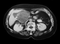 Cystic Pancreas Tumour, CT Scan-ZEPHYR-Photographic Print