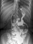 Cystic Pancreas Tumour, CT Scan-ZEPHYR-Photographic Print