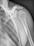 Normal Shoulder, X-ray-ZEPHYR-Photographic Print