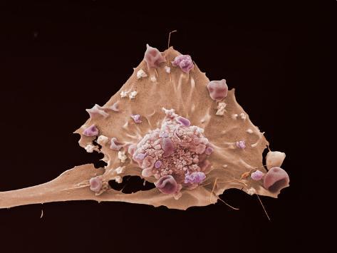 breast cancer electron microscope Breast cancer electron microscope