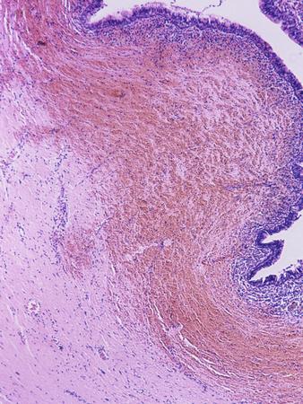 Cross-Section of the Human Vulva Showing Bartholin's Cyst ...