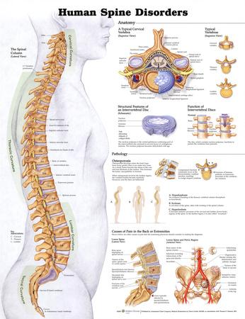 'Human Spine Disorders Anatomical Chart Poster Print' Posters