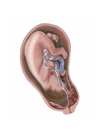 Pregnancy Complication, Placenta Previa Prints at ...