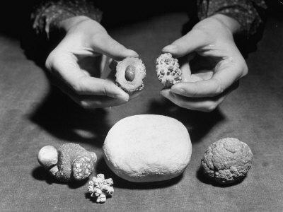 'Stones Formed by Minerals Deposited in Human Bladder and Kidneys