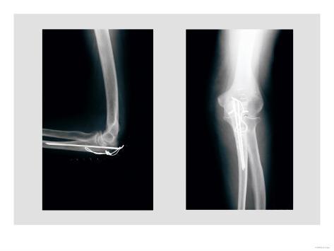 right elbow repair fx xray photo right elbow repair fx xray photo