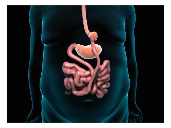 Abdominal Anatomy After Gastric Bypass : 17 61-year-old ...