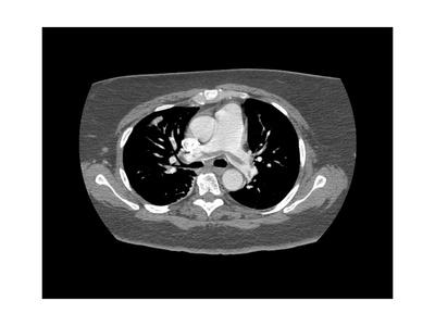 Pulmonary Embolism, CT Scan Giclee Print by Du Cane ...