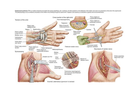 Essay On Carpal Tunnel Syndrome