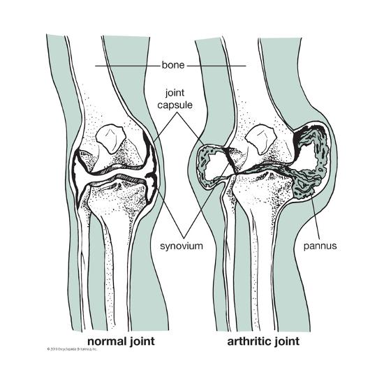 'Comparison of Knee Joints' Art - | AllPosters.com