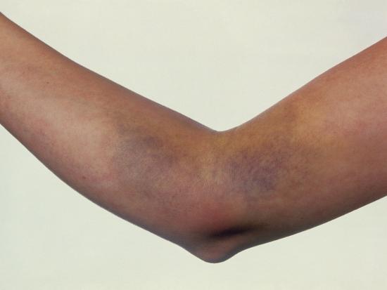 �Bruising on Woman�s Arm After Blood Test� Photographic