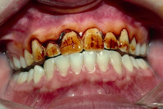 Teeth Showing Plaque Photographic Print by Science Photo ...
