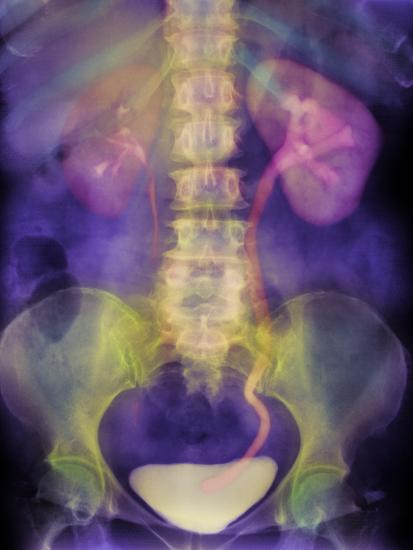 Kidney stone analysis image