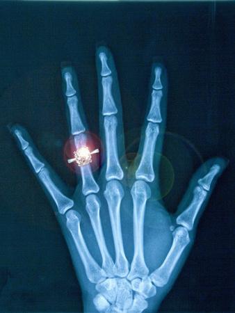 x ray of hand with diamond ring photographic print thom lang