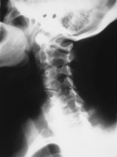 X-Ray Normal Cervical Spine Lateral View Photographic ...