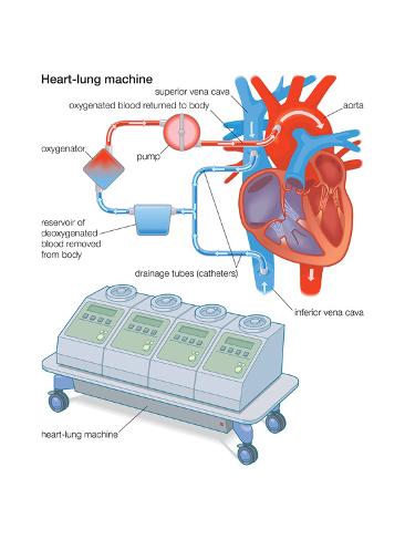 HeartLung Machine Print by Encyclopaedia Britannica at