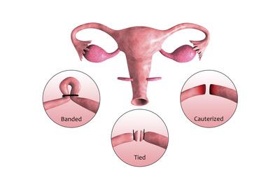 tubal ligation tubectomy tubektomi biomedical stocktrek ikat laparoscopic dulu syarat prosedurnya pahami peranakan berencana